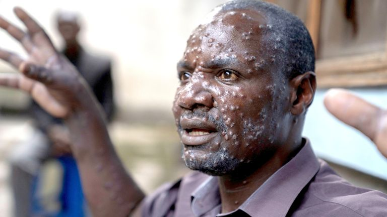Congo Declares End Of Deadly Monkey-Pox Outbreak After Two Years
